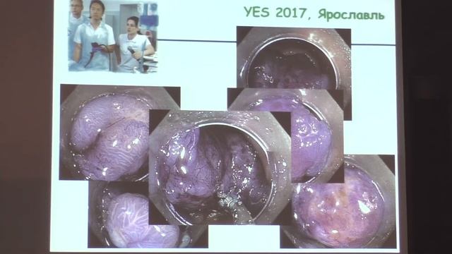 09 Кашин СВ Эпителиальные образования толстой кишки Классификации Методики удаления смотреть онлайн