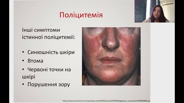 Симптоми і синдроми захворювань системи крові смотреть онлайн