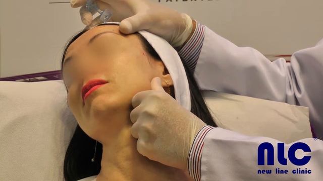 Процедура введения филлера Stylage XL с лидокаином. Скуловая область. Врач - Валерий Потий.