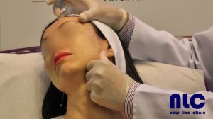 Процедура введения филлера Stylage XL с лидокаином. Скуловая область. Врач - Валерий Потий.