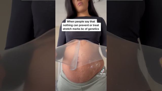 Clinically proven stretch mark treatment ❤️ смотреть онлайн