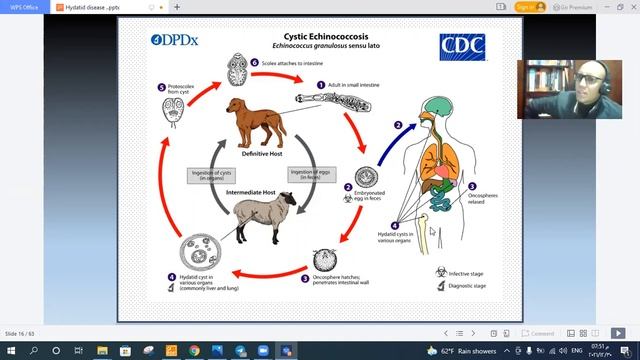 #GIT #Parasitology #Hydatid Disease #Life Cycle #Clinical Feature смотреть онлайн