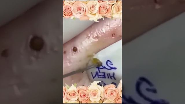 Blackheads Popping - 9 смотреть онлайн