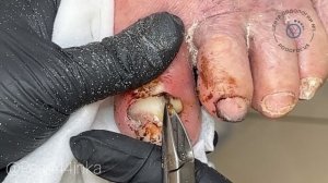 Черные ногти/ гной под ногтями/ как срезать толстые ногти