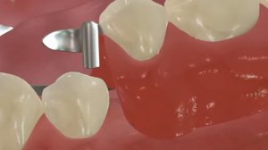 Протезирование Бюгельный нижний протез с замковой фиксацией