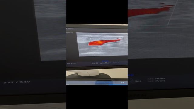 Сосудистые сетки на ногах. Идеальные вены на УЗИ. Флеболог. Флеболог Москва. Сосудистый хирург смотреть онлайн