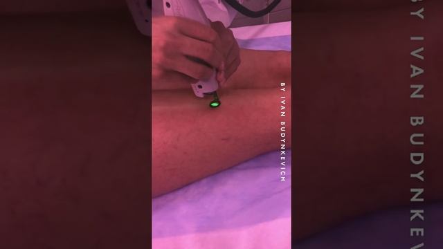 Лазерное устранение сосудистой сетки на ногах смотреть онлайн