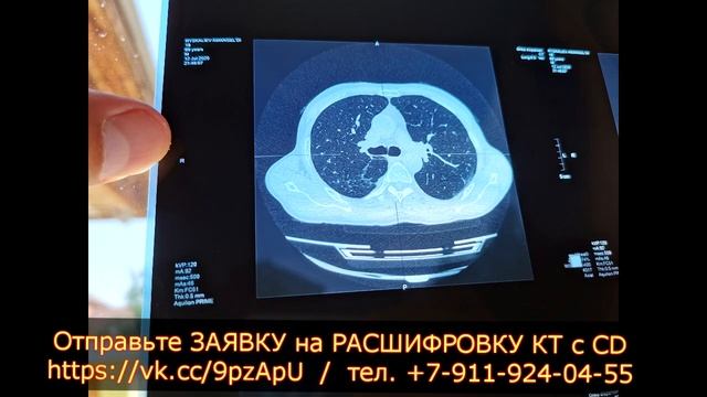 ФИБРОЗНЫЕ ИЗМЕНЕНИЯ в легких 40% поражения и буллы правого легкого на КТ расшифровке смотреть онлайн