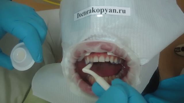 Люминиры установка ч.1 смотреть онлайн