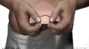 Уход за стомой.Опорожнение калоприемника.