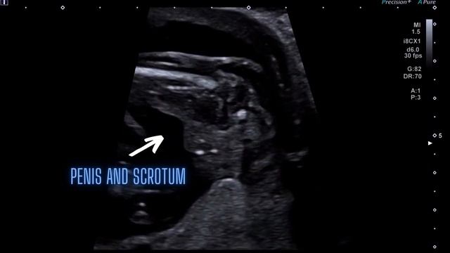 Ultrasound Pregnancy showing boy gender 13 weeks to 36 weeks. Key identification. смотреть онлайн