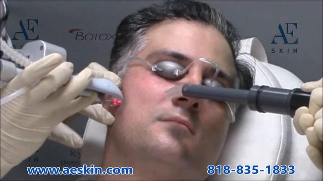 Fractional CO2 Demonstration 17 - A E Skin - Encino, CA - 818-835-1833 смотреть онлайн