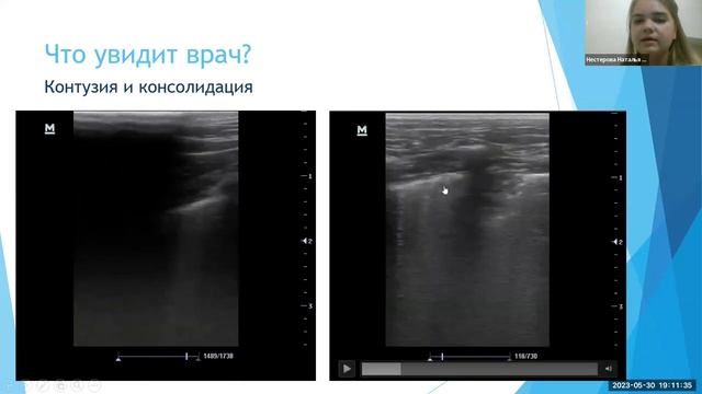 УЗИ легких при падении с высоты когда, где и зачем СД Нестерова Н С смотреть онлайн