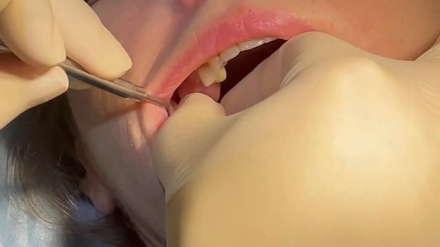 Примерка коронки в полости рта.