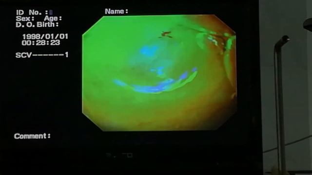 upper gastrointestinal endoscopy GIT number 2 смотреть онлайн