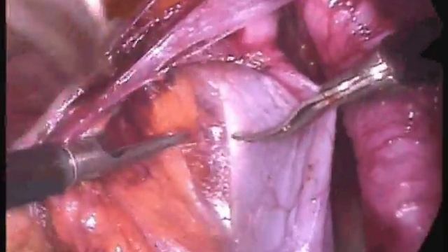 Standart technique for laparoscopic pelvic lymph node dissection смотреть онлайн
