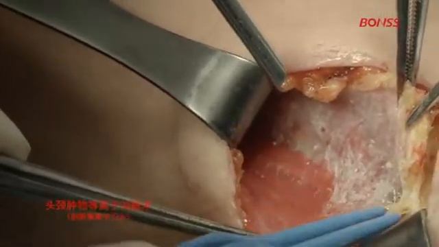 BONSS Plasma - ORL-HNS Thyroid Tumor, Head and Neck lymph node dissection смотреть онлайн