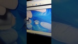 Установка коффердам изоляция глубоких дефектов