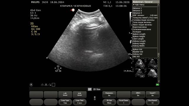 Щитовидная железа узел TIRADS 2, обпп норм 15 лет 2020 06 15 15 00 24 смотреть онлайн
