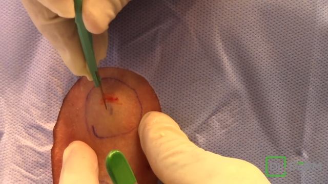 The WATCH OUT! Exploding Cysts | Dr. Derm смотреть онлайн