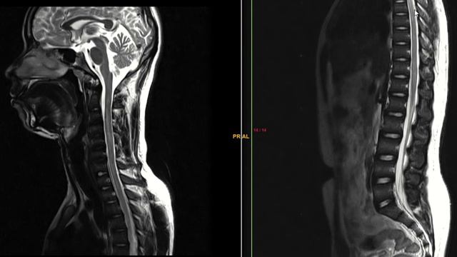 Transverse myelitis D/D Neuromyelitis opticans: MRI cervical spine смотреть онлайн