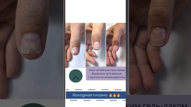Холодная плазма (видео №2) смотреть онлайн
