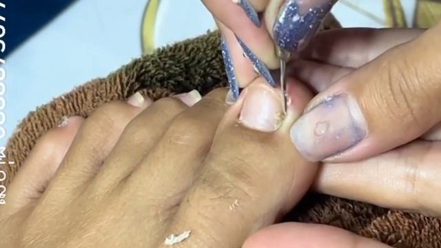 Лучший способ удалить и обрезать вросший ноготь в домашних условиях