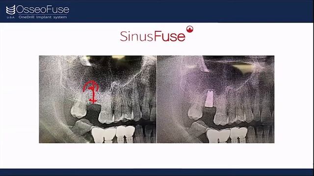 Part 3/3 OsseoFuse "Sinus Implant" (FRENCH): Dr. Leon Chen ZOOM lecture '22 смотреть онлайн