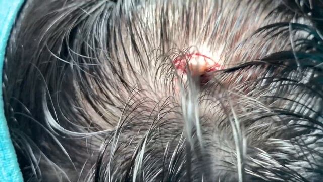 Papilloma Removal смотреть онлайн