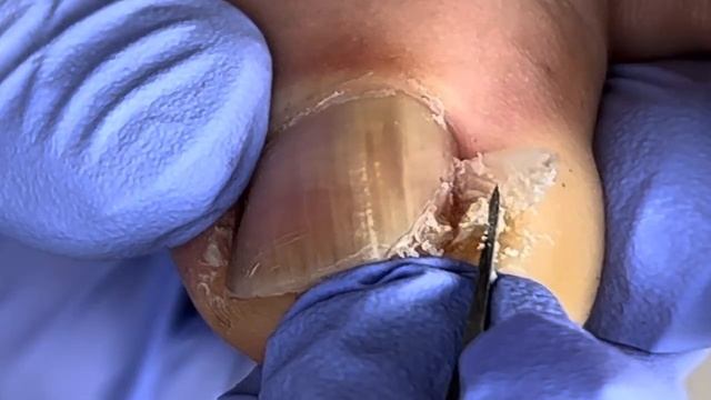 Uñas de los pies cortadas por el paciente, curvadas hacia adentro. смотреть онлайн