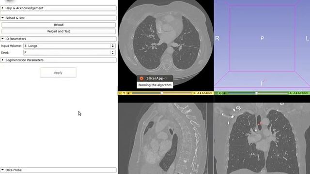 Airway Segmentation Tutorial смотреть онлайн