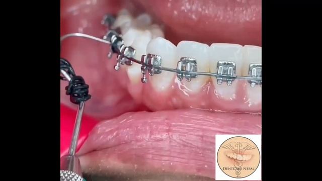 How to change Elastic Modules during Orthodontic Follow Up Treatment смотреть онлайн