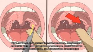 Причины появления белых комочков и гнойных пробок на миндалинах