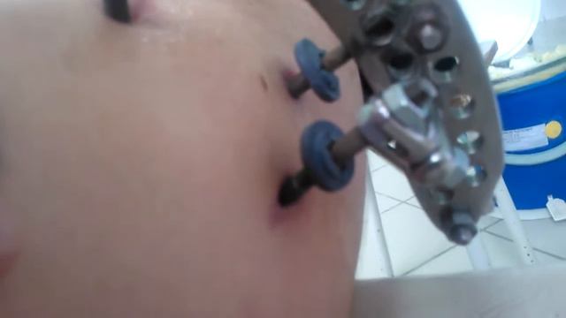 перевязка тазабедренной части аппарата елизарова