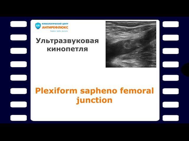 Plexiform sapheno femoral junction смотреть онлайн