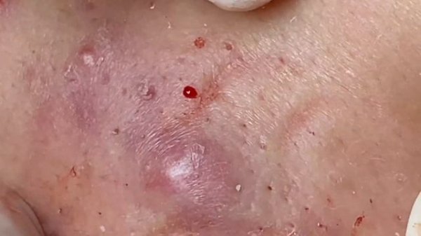 Чистка лица. Комедоны.