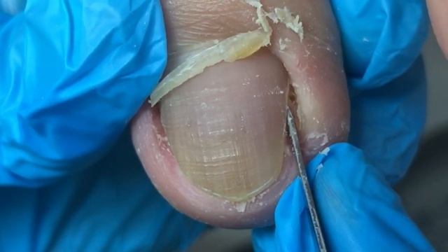 Easily Trim Ingrown Nails And Make Your Feet Comfortable~【Crazy Pedicure Room】