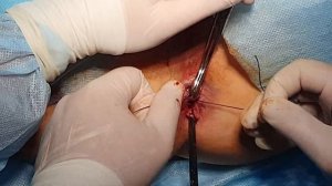 Иссечение заднего неполного внутреннего свища прямой кишки, иссечение полипа анального канала