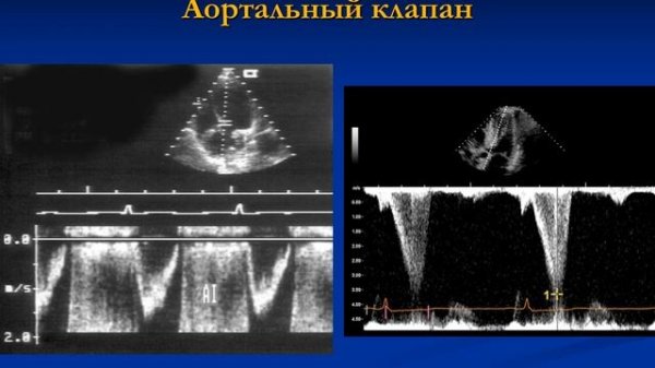 ЭхоКГ 2020 Dist 1 и 2 часть