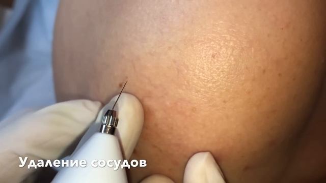 Плазменный Коагулятор KS-12 смотреть онлайн