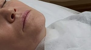 Коррекция овала лица и подбородка плотным филлером.