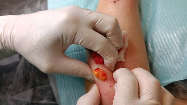 Удаление липом при липоматозе