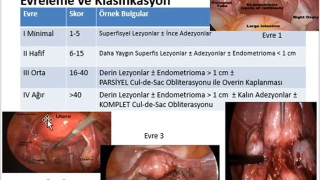 Endometriozis, YDU смотреть онлайн