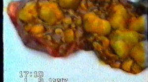 1)Острый гангренозный калькулёзный холецистит.2)Эмпиема желчного пузыря.3)Водянка желчного пузыря.