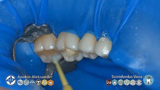 Caries class-I 36 35 34 Ivoclar EvoCeram Syntac Sanctuary FABRI TorVM (multistream) смотреть онлайн