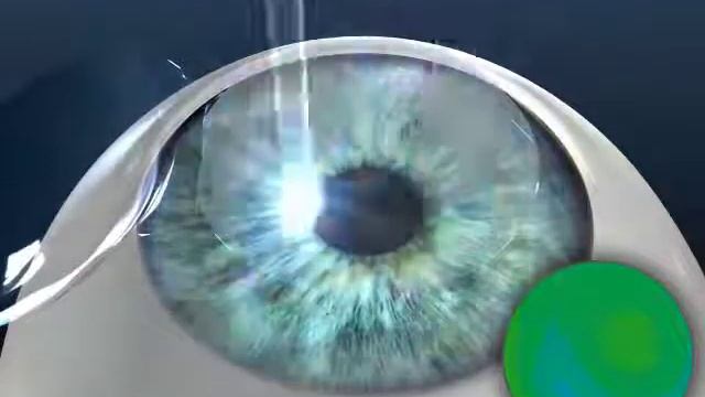 How CustomVue LASIK Treatment Works смотреть онлайн