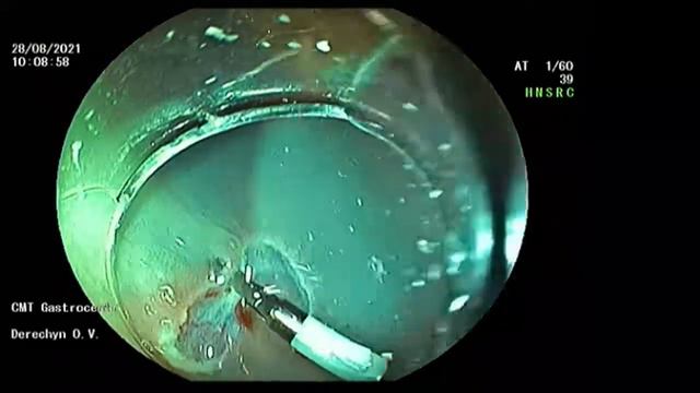 Аденома сигмы, удаление под водой. 2021 08 28 10 01 24 П13908П