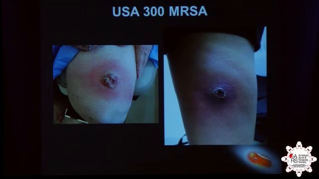 Methicillin-Resistant Staphyloccocus Aureus (MRSA) Overview смотреть онлайн