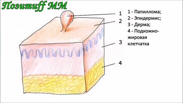 Топ 3 ЛУЧШИХ способа БЫСТРО удалить папиллому ДОМА. смотреть онлайн