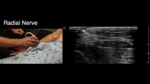 Идентификация лучевого нерва (POCUS Guided Regional Anesthesia)
